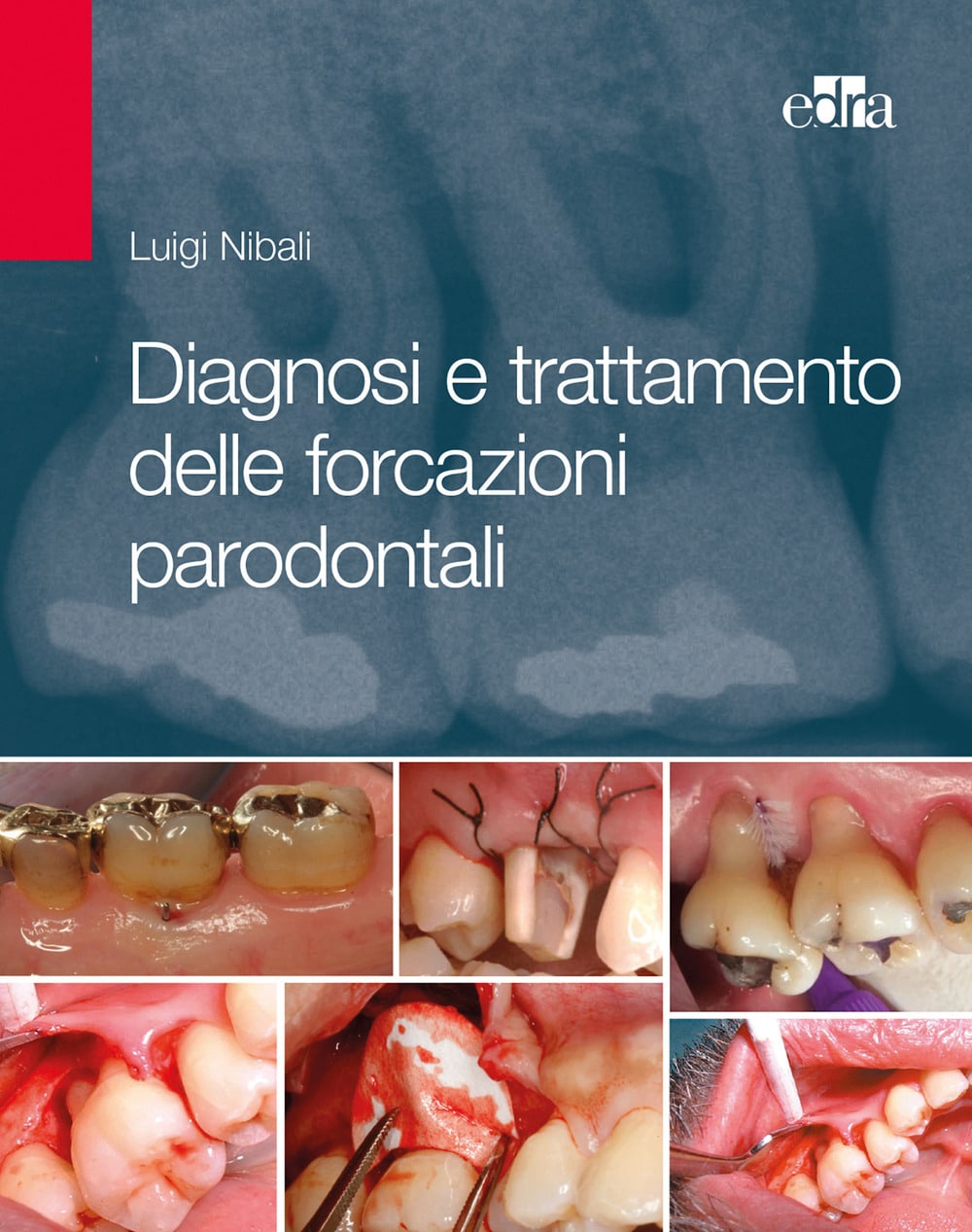 Copertina di Luigi Nibali, Diagnosi e trattamento delle forcazioni parodontali.